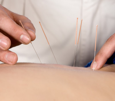 Photo of a physiotherapists hands performing dry needling on a persons lower back muscles.